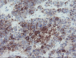 MYL7 Antibody - IHC of paraffin-embedded Carcinoma of Human pancreas tissue using anti-MYL7 mouse monoclonal antibody.