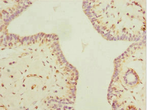 MYLK3 Antibody - Immunohistochemistry of paraffin-embedded human breast cancer at dilution 1:100