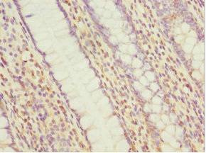MYLK3 Antibody - Immunohistochemistry of paraffin-embedded human colon cancer at dilution 1:100