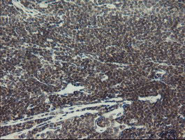 MYNN Antibody - IHC of paraffin-embedded Human lymphoma tissue using anti-MYNN mouse monoclonal antibody.