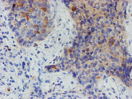 MYNN Antibody - IHC of paraffin-embedded Carcinoma of Human lung tissue using anti-MYNN mouse monoclonal antibody.