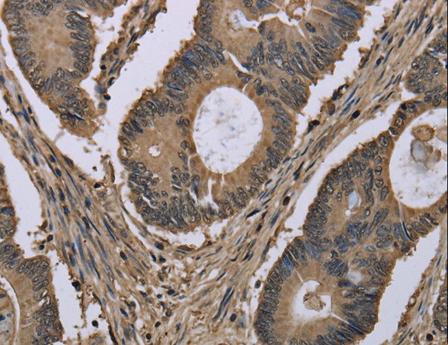 MYO18B / Myosin 18B Antibody - Immunohistochemistry of paraffin-embedded Human prostate cancer using MYO18B Polyclonal Antibody at dilution of 1:50.