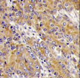 MYO1C Antibody - Formalin-fixed and paraffin-embedded human prostate carcinoma tissue reacted with MYO1C antibody , which was peroxidase-conjugated to the secondary antibody, followed by DAB staining. This data demonstrates the use of this antibody for immunohistochemistry; clinical relevance has not been evaluated.