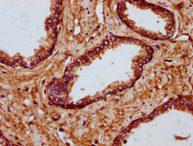 MYO1E / Myosin IE Antibody - Immunohistochemistry Dilution at 1:700 and staining in paraffin-embedded human prostate tissue performed on a Leica BondTM system. After dewaxing and hydration, antigen retrieval was mediated by high pressure in a citrate buffer (pH 6.0). Section was blocked with 10% normal Goat serum 30min at RT. Then primary antibody (1% BSA) was incubated at 4°C overnight. The primary is detected by a biotinylated Secondary antibody and visualized using an HRP conjugated SP system.