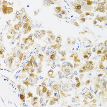 MYO5A / Myosin V Antibody - Immunohistochemistry of paraffin-embedded human liver cancer tissue.