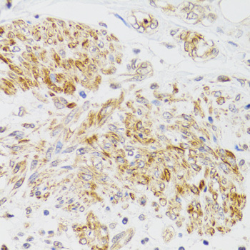 MYO5A / Myosin V Antibody - Immunohistochemistry of paraffin-embedded human prostate cancer tissue.