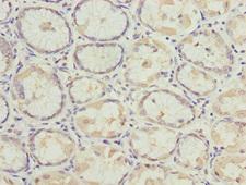 MYO5C Antibody - Immunohistochemistry of paraffin-embedded human gastric cancer at dilution 1:100