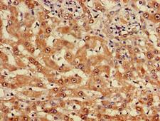 MYO7A / Myosin-VIIa Antibody - Immunohistochemistry of paraffin-embedded human liver cancer using MYO7A Antibody at dilution of 1:100