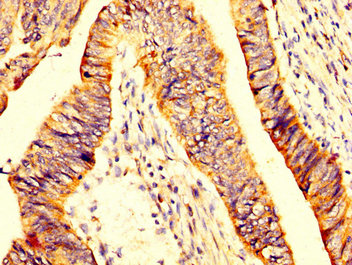 MYOC / Myocilin Antibody - Immunohistochemistry image at a dilution of 1:200 and staining in paraffin-embedded human colon cancer performed on a Leica BondTM system. After dewaxing and hydration, antigen retrieval was mediated by high pressure in a citrate buffer (pH 6.0) . Section was blocked with 10% normal goat serum 30min at RT. Then primary antibody (1% BSA) was incubated at 4 °C overnight. The primary is detected by a biotinylated secondary antibody and visualized using an HRP conjugated SP system.
