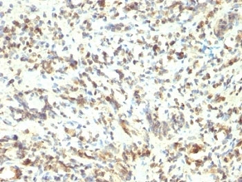 MYOD / MYOD1 Antibody - Formalin-fixed, paraffin-embedded human Rhabdomyosarcoma stained with MyoD1 antibody (5.8A).  This image was taken for the unmodified form of this product. Other forms have not been tested.