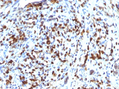 MYOD / MYOD1 Antibody - Formalin-fixed, paraffin-embedded human Rhabdomyosarcoma stained with MyoD1 Mouse Monoclonal Antibody (MYOD1/2075R).