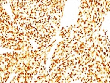 MYOD / MYOD1 Antibody - Formalin-fixed, paraffin-embedded human Rhabdomyosarcoma stained with anti-MyoD1 antibody (SPM427).  This image was taken for the unmodified form of this product. Other forms have not been tested.