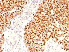 MYOG / Myogenin Antibody - Formalin-fixed, paraffin-embedded human Rhabdomyosarcoma stained with Myogenin antibody (F5D).  This image was taken for the unmodified form of this product. Other forms have not been tested.
