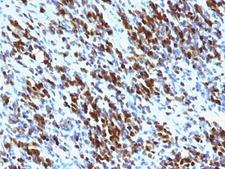 MYOG / Myogenin Antibody - Formalin-fixed, paraffin-embedded human Rhabdomyosarcoma stained with Myogenin antibody (MGN185+F5D).  This image was taken for the unmodified form of this product. Other forms have not been tested.