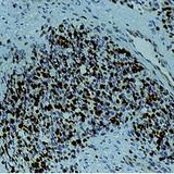 MYOG / Myogenin Antibody - Formalin-fixed, paraffin-embedded human rhabdomyosarcoma stained with Myogenin antibody.