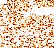 MYOG / Myogenin Antibody - Myogenin antibody MGN185 immunohistochemistry rhabdomyosarcoma.  This image was taken for the unmodified form of this product. Other forms have not been tested.