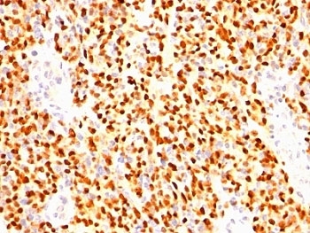 MYOG / Myogenin Antibody - Formalin-fixed, paraffin-embedded human rhabdomyosarcoma stained with anti-Myogenin antibody (SPM144).  This image was taken for the unmodified form of this product. Other forms have not been tested.