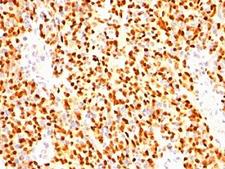 MYOG / Myogenin Antibody - Formalin-fixed, paraffin-embedded human rhabdomyosarcoma stained with anti-Myogenin antibody (SPM144).  This image was taken for the unmodified form of this product. Other forms have not been tested.