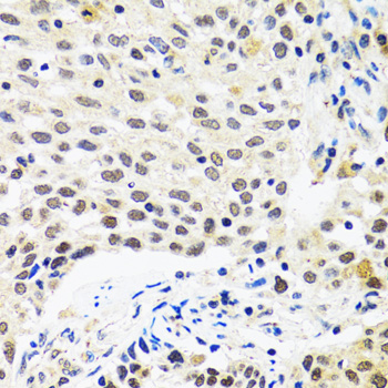 MYOG / Myogenin Antibody - Immunohistochemistry of paraffin-embedded human lung cancer tissue.