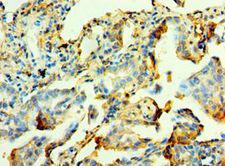 MYOT / Myotilin Antibody - Immunohistochemistry of paraffin-embedded human lung cancer using antibody at 1:100 dilution.