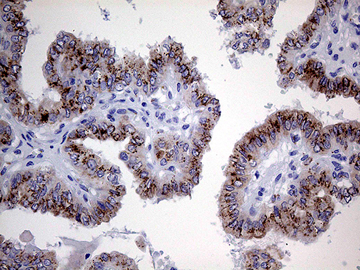 MYOT / Myotilin Antibody - Immunohistochemical staining of paraffin-embedded Carcinoma of Human thyroid tissue using anti-MYOT mouse monoclonal antibody. (Heat-induced epitope retrieval by 1mM EDTA in 10mM Tris buffer. (pH8.5) at 120°C for 3 min. (1:1000)