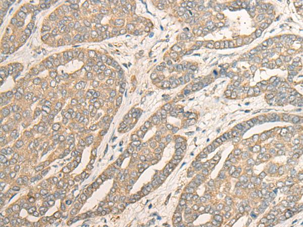 MYOZ2 / CS-1 Antibody - Immunohistochemistry of paraffin-embedded Human liver cancer tissue  using MYOZ2 Polyclonal Antibody at dilution of 1:40(×200)