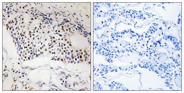 MYSM1 Antibody - Immunohistochemistry analysis of paraffin-embedded human breast carcinoma, using MYSM1 Antibody. The picture on the right is blocked with the synthesized peptide.