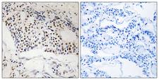 MYSM1 Antibody - Immunohistochemistry analysis of paraffin-embedded human breast carcinoma, using MYSM1 Antibody. The picture on the right is blocked with the synthesized peptide.
