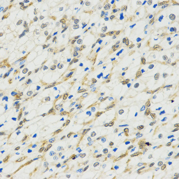 MYSM1 Antibody - Immunohistochemistry of paraffin-embedded human kidney cancer tissue.