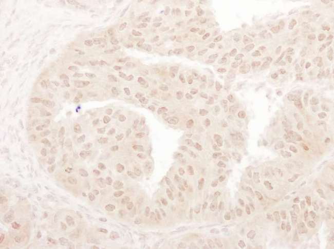 MYST1 Antibody - Detection of Human MOF/MYST1 by Immunohistochemistry. Sample: FFPE section of human ovarian carcinoma. Antibody: Affinity purified rabbit anti-MOF/MYST1 used at a dilution of 1:1000 (1 ug/ml). Detection: DAB.