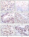 MYST1 Antibody - IHC of paraffin-embedded human esophageal squamous cell carcinoma (A), normal esophagus epithelium (B), rectum adenocarcinoma (C), lung squamous cell carcinoma (D), breast infiltrating carcinoma (E), and breast infiltrat
