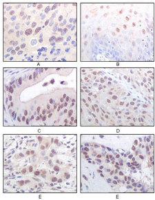 MYST1 Antibody - IHC of paraffin-embedded human esophageal squamous cell carcinoma (A), normal esophagus epithelium (B), rectum adenocarcinoma (C), lung squamous cell carcinoma (D), breast infiltrating carcinoma (E), and breast infiltrat