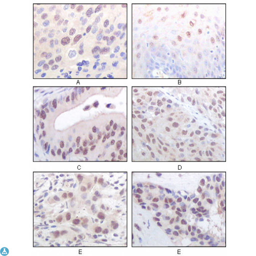 MYST1 Antibody - Immunohistochemistry (IHC) analysis of paraffin-embedded human esophageal squamous cell carcinoma (A), normal esophagus epithelium (B), rectum adenocarcinoma (C), lung squamous cell carcinoma (D), breast infiltrating carcinoma (E), and breast infiltrating carci.