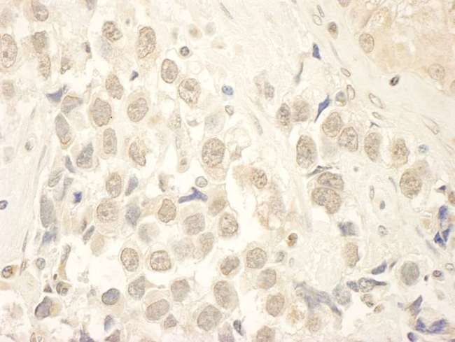 MYST2 / HBO1 Antibody - FFPE section of human testicular seminoma.  Rabbit anti-HBO IHC Antibody, Affinity Purified used at a dilution of 1:250.