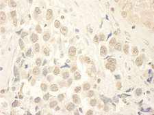 MYST2 / HBO1 Antibody - FFPE section of human testicular seminoma.  Rabbit anti-HBO IHC Antibody, Affinity Purified used at a dilution of 1:250.
