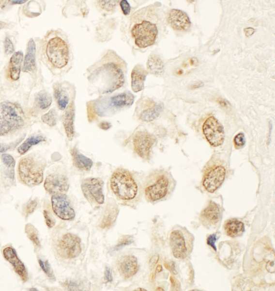 MYST2 / HBO1 Antibody - Detection of Human HBO by Immunohistochemistry. Sample: FFPE section of human testicular seminoma. Antibody: Affinity purified rabbit anti-HBO used at a dilution of 1:200 (1 Detection: DAB.