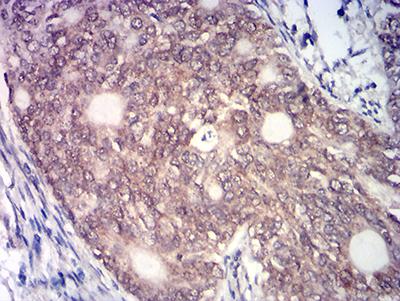 MYST2 / HBO1 Antibody - Immunohistochemical analysis of paraffin-embedded cervical cancer tissues using KAT7 mouse mAb with DAB staining.