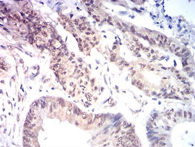 MYST2 / HBO1 Antibody - Immunohistochemical analysis of paraffin-embedded colon cancer tissues using KAT7 mouse mAb with DAB staining.