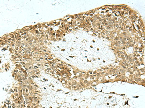 MYST2 / HBO1 Antibody - Immunohistochemistry of paraffin-embedded Human breast cancer tissue  using KAT7 Polyclonal Antibody at dilution of 1:55(×200)
