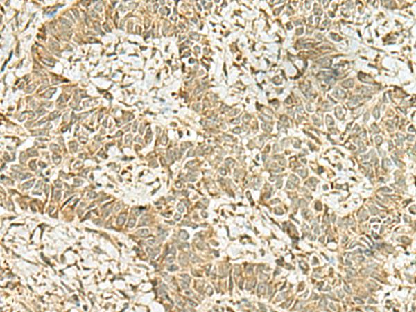 MYST2 / HBO1 Antibody - Immunohistochemistry of paraffin-embedded Human ovarian cancer tissue  using KAT7 Polyclonal Antibody at dilution of 1:45(×200)