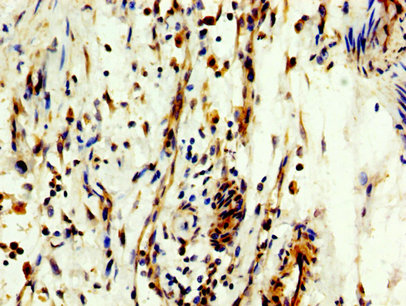 MYT1 Antibody - Immunohistochemistry image at a dilution of 1:300 and staining in paraffin-embedded human bladder cancer performed on a Leica BondTM system. After dewaxing and hydration, antigen retrieval was mediated by high pressure in a citrate buffer (pH 6.0) . Section was blocked with 10% normal goat serum 30min at RT. Then primary antibody (1% BSA) was incubated at 4 °C overnight. The primary is detected by a biotinylated secondary antibody and visualized using an HRP conjugated SP system.