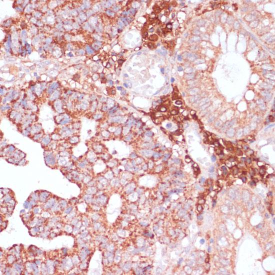 MZB1 Antibody - Immunohistochemistry of paraffin-embedded Human colon carcinoma using MZB1 Polyclonal Antibody at dilution of 1:100 (40x lens).