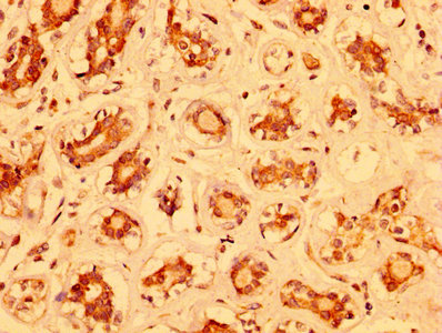 MZF / MZF1 Antibody - Immunohistochemistry image at a dilution of 1:400 and staining in paraffin-embedded human breast cancer performed on a Leica BondTM system. After dewaxing and hydration, antigen retrieval was mediated by high pressure in a citrate buffer (pH 6.0) . Section was blocked with 10% normal goat serum 30min at RT. Then primary antibody (1% BSA) was incubated at 4 °C overnight. The primary is detected by a biotinylated secondary antibody and visualized using an HRP conjugated SP system.