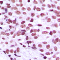 MZF / MZF1 Antibody - Immunohistochemical analysis of MZF1 staining in human breast cancer formalin fixed paraffin embedded tissue section. The section was pre-treated using heat mediated antigen retrieval with sodium citrate buffer (pH 6.0). The section was then incubated with the antibody at room temperature and detected using an HRP conjugated compact polymer system. DAB was used as the chromogen. The section was then counterstained with hematoxylin and mounted with DPX.