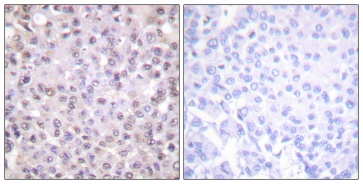 N-CoR / NCOR1 Antibody - Immunohistochemistry analysis of paraffin-embedded human breast carcinoma tissue, using NCoR1 Antibody. The picture on the right is blocked with the synthesized peptide.