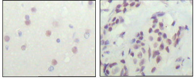 N-CoR / NCOR1 Antibody - IHC of paraffin-embedded human cerebra (left) and breast carcinoma tissue (right), showing nuclear location with DAB staining using NCOR1 mouse monoclonal antibody.