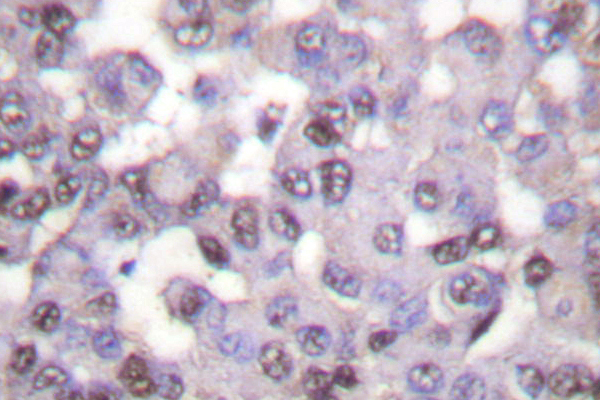 N-CoR / NCOR1 Antibody - IHC of NCoR1 (H76) pAb in paraffin-embedded human breast carcinoma tissue.