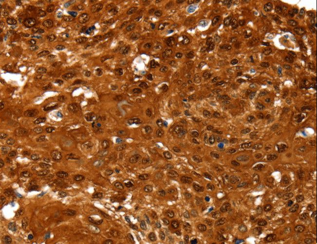 N-CoR / NCOR1 Antibody - Immunohistochemistry of paraffin-embedded Human esophagus cancer using NCOR1 Polyclonal Antibody at dilution of 1:60.