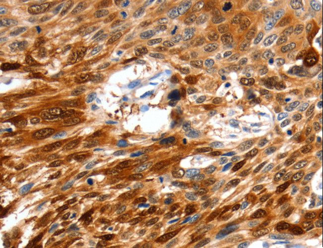 N-CoR / NCOR1 Antibody - Immunohistochemistry of paraffin-embedded Human esophagus cancer using NCOR1 Polyclonal Antibody at dilution of 1:60.