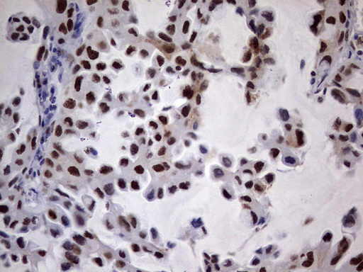 N4BP2L2 Antibody - Immunohistochemical staining of paraffin-embedded Carcinoma of Human lung tissue using anti-N4BP2L2 mouse monoclonal antibody. (Heat-induced epitope retrieval by 1 mM EDTA in 10mM Tris, pH8.5, 120C for 3min,